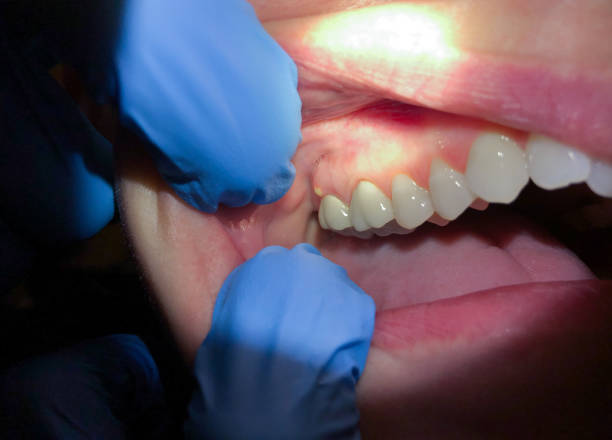 Best Lost Filling or Crown Replacement in Valley View, OH